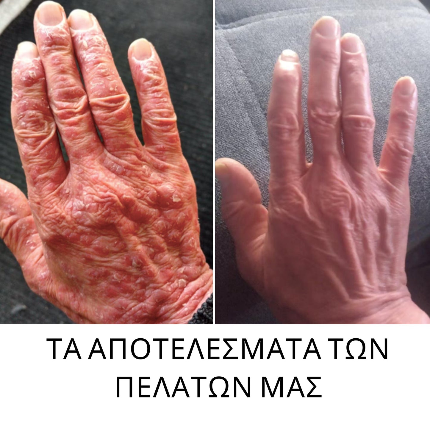 Ψωρίαση RoutINA™ - λύση που διαρκεί για την Ψωρίαση και το Ευαίσθητο δέρμα Cosmetics InaEssentials Ελλαδα