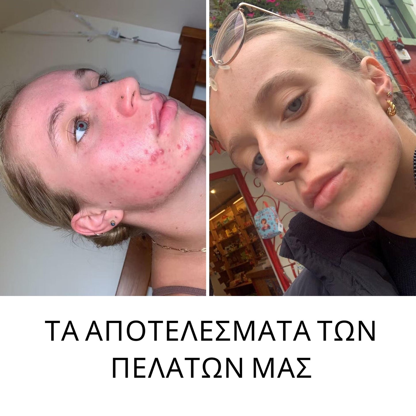 Hydrobiotic - Λεβάντα και Μέντα - εντατική θεραπεία κατά της ΑΚΜΗΣ (150ml) Cosmetics InaEssentials Ελλαδα