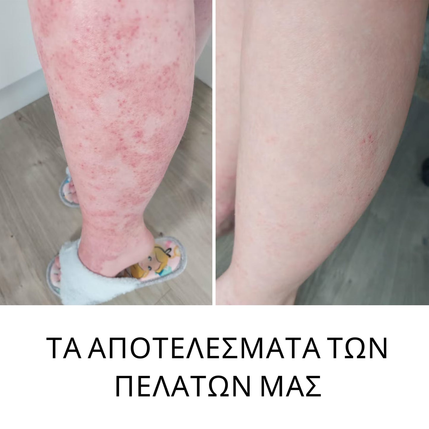 Remorrhoids – Αγριοκάστανο και Χρυσόξυλο για ΚΙΡΣΟΥΣ και ΑΙΜΟΡΡΟΪΔΕΣ – 30ml (Κρέμα) Cosmetics InaEssentials Ελλαδα