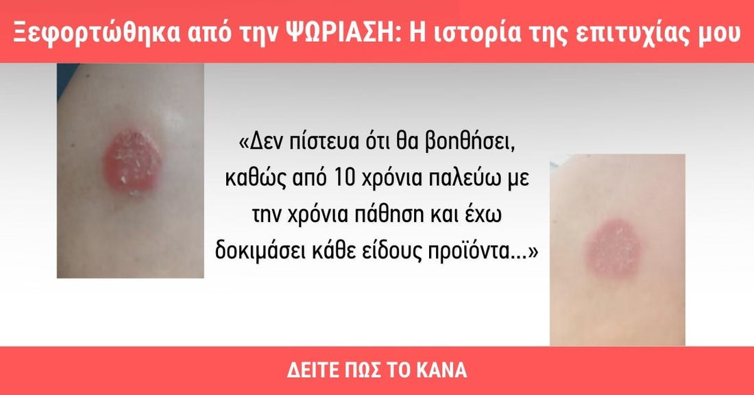 Απαλλάχθηκα από την ψωριαση: Η ιστορία μου προς την επιτυχία