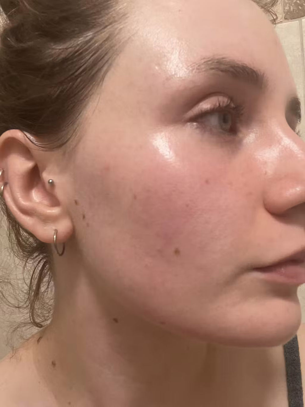 acne GR keep
