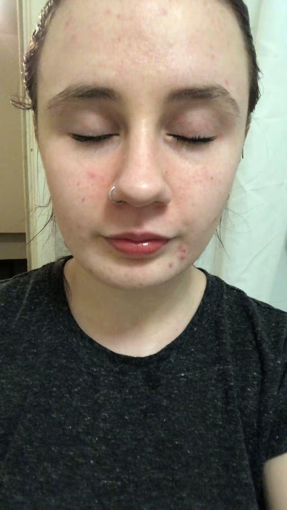 acne GR keep