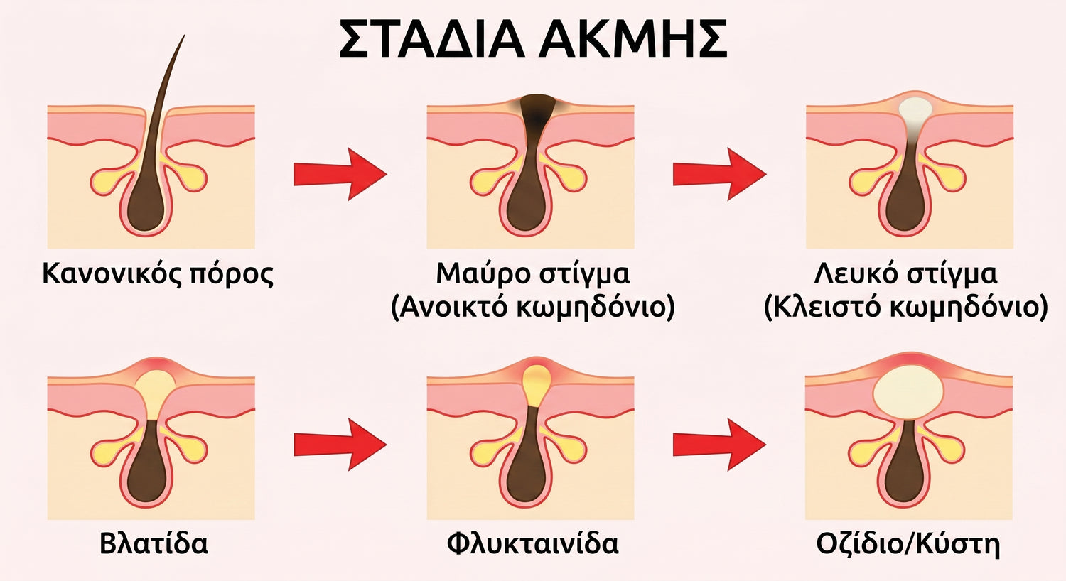 acne GR translated